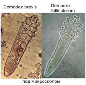 розацеа демодекс