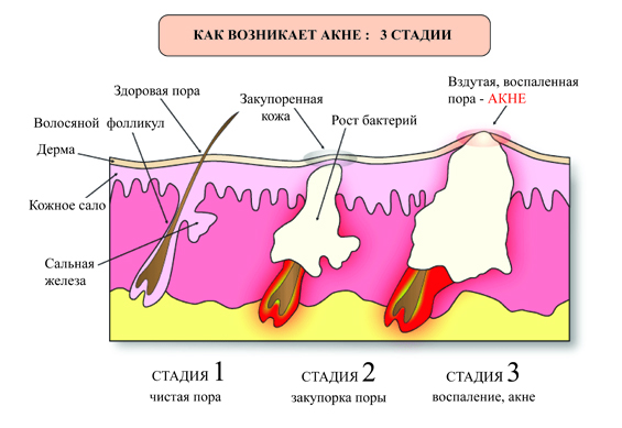 причины акне