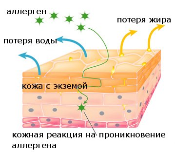 экзема