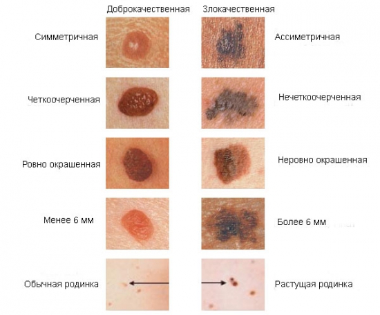 отличие меланомы от родинок